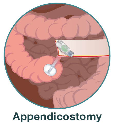 Appendicostomy