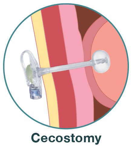 Cecostomy