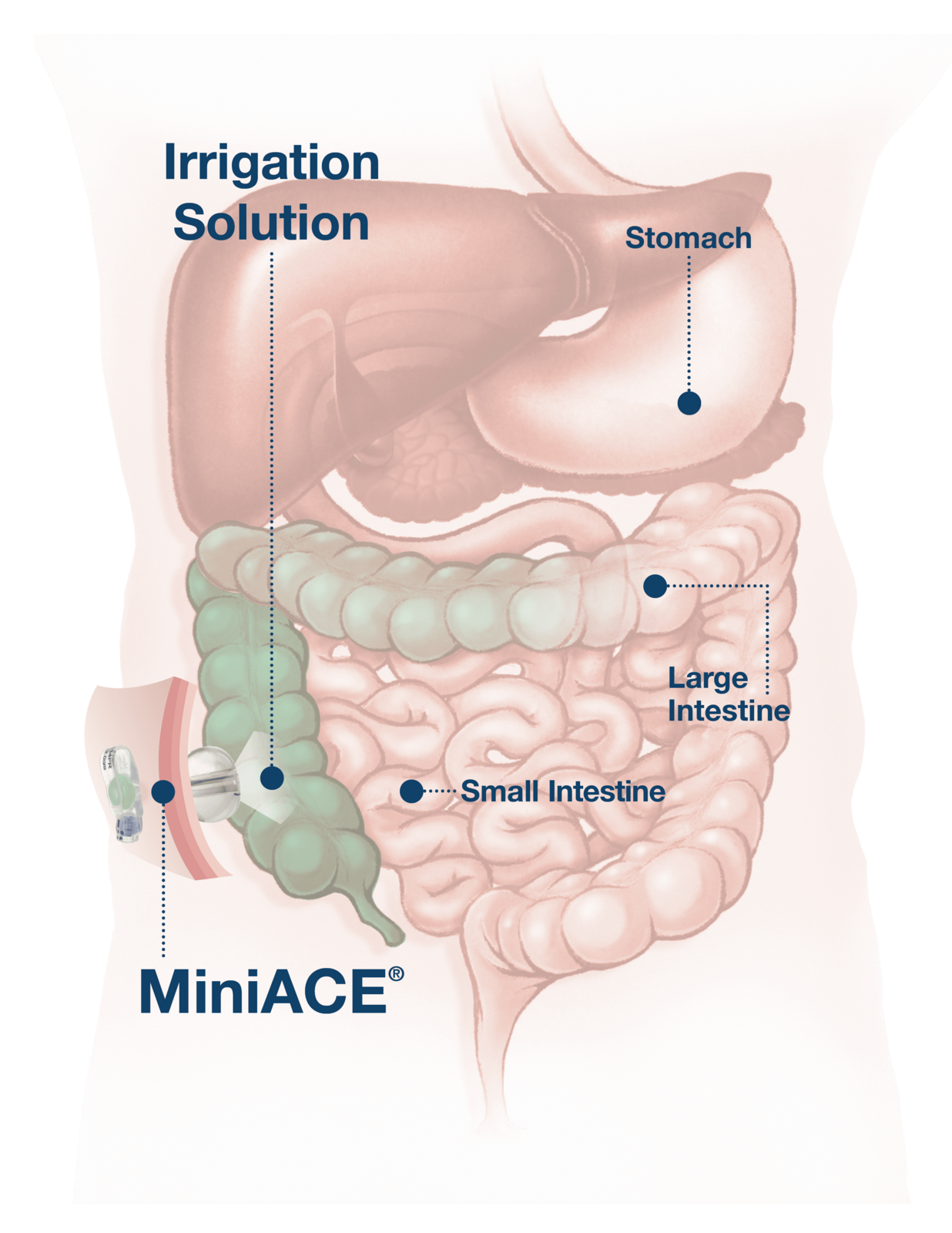 What is an Antegrade Enema?