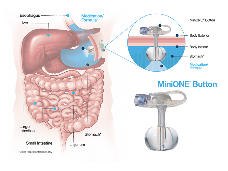 New to enteral feeding?